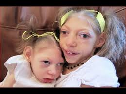 مایکروسیفالي